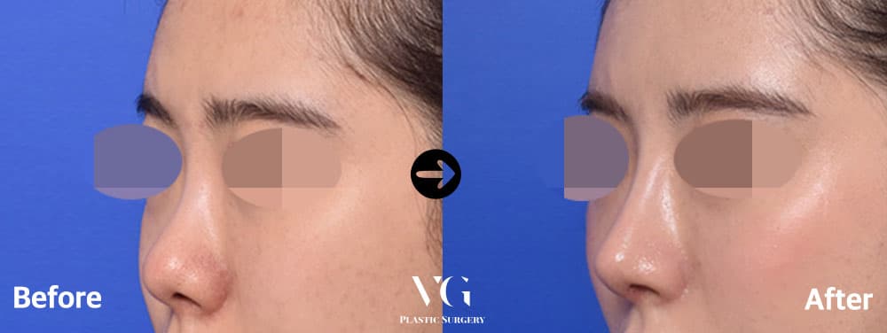 Rhinoplasty before and after — case 457