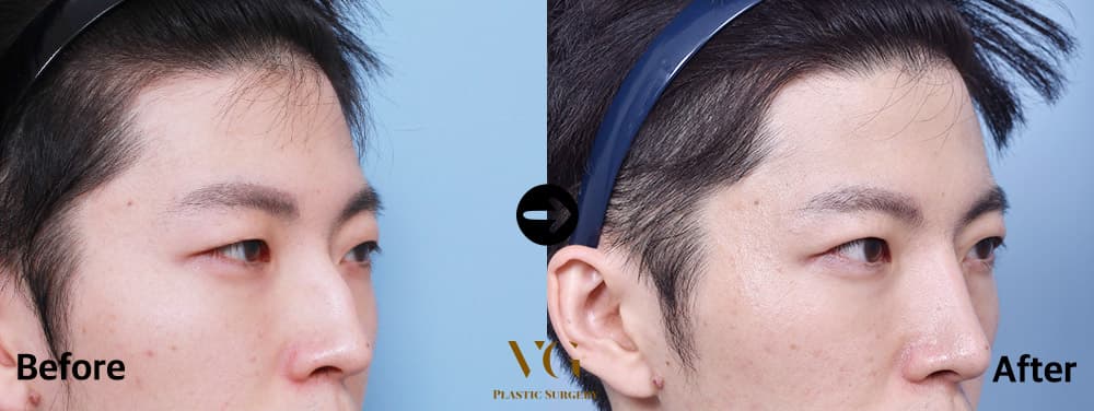 Rhinoplasty before and after — case 460