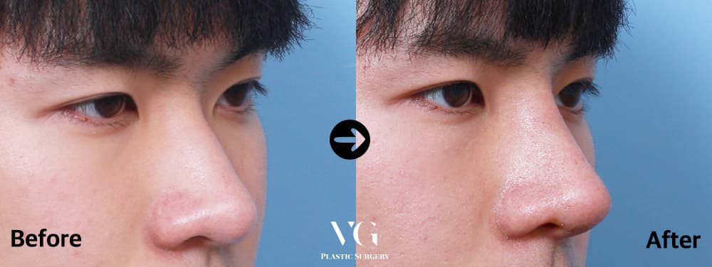 Rhinoplasty before and after — case 462