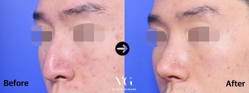 Rhinoplasty before and after — case 463