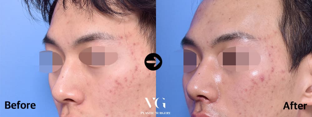 Male Rhinoplasty