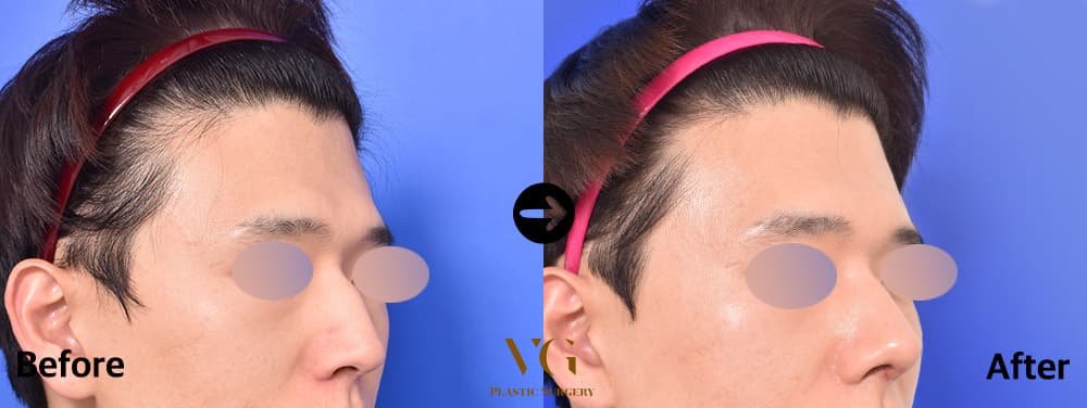 Male Rhinoplasty
