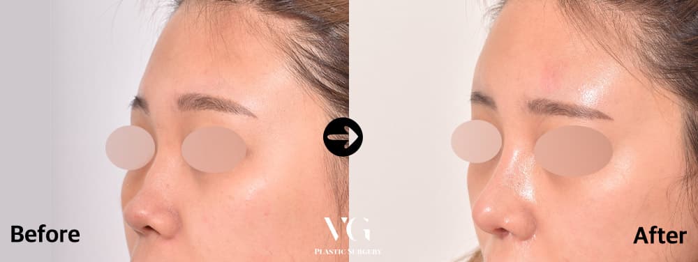 Rhinoplasty