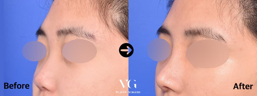 Rhinoplasty