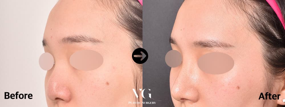 Rhinoplasty + Hump Reduction