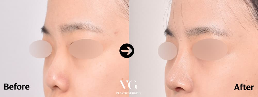 Rhinoplasty
