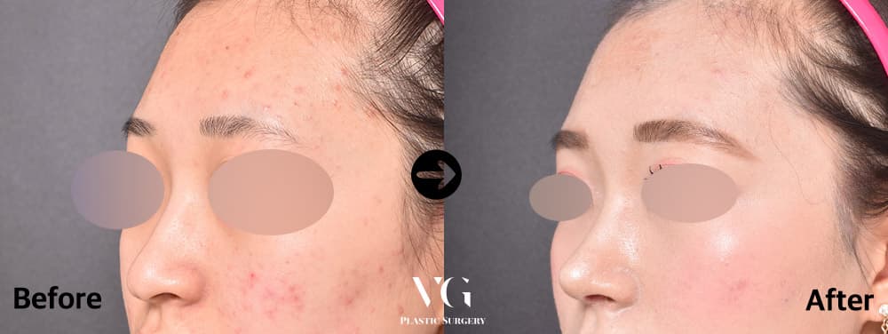 Rhinoplasty