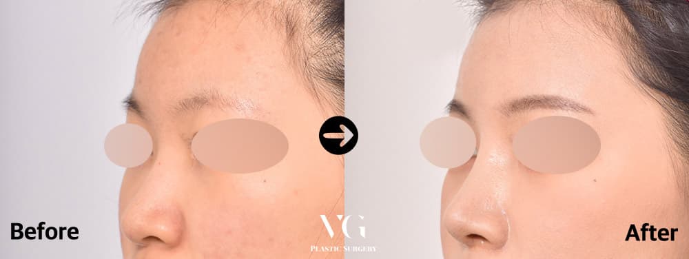 Rhinoplasty