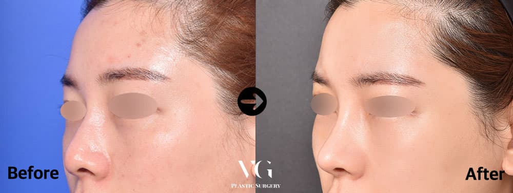Rhinoplasty + Donor Rib Cartilage