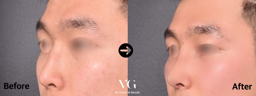 Deviated Nose Correction + Hump Reduction + Dorsal Augmentation