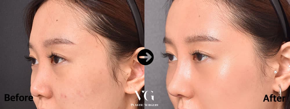 Dorsal Augmentation + Donor Rib Cartilage + Deviated Nose Correction