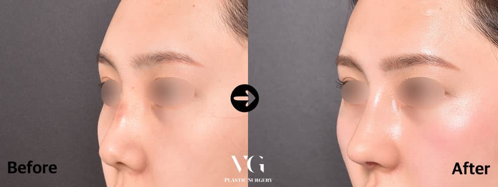 Dorsal Augmentation