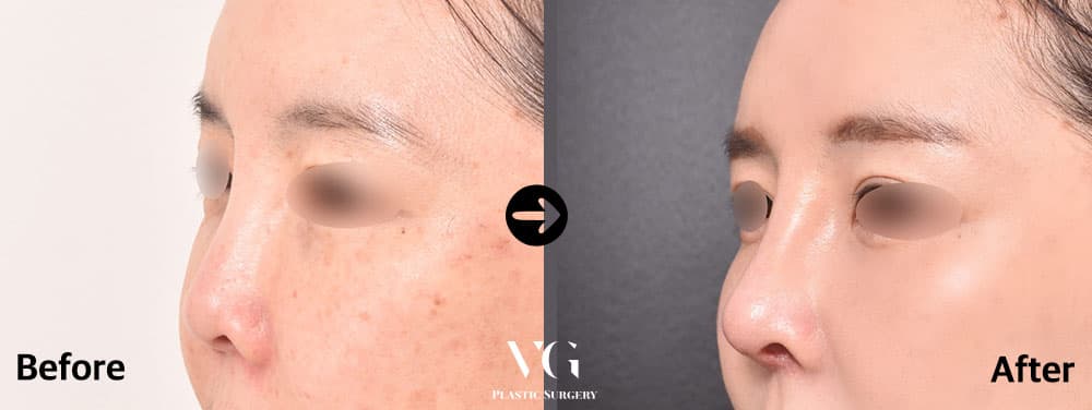 Dorsal Augmentation + Short Nose Correction