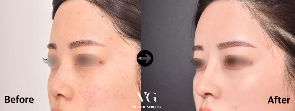Dorsal Augmentation