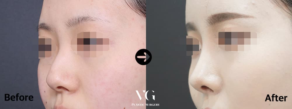 Rhinoplasty + Hump Reduction + Bulbous Tip Correction
