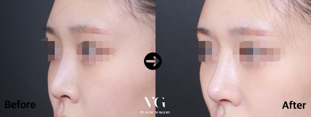 Revision Rhinoplasty + Nostril Shaping