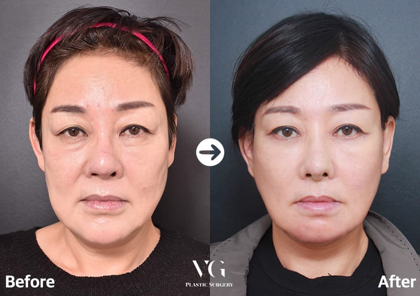Revision Rhinoplasty + Face Lift + Upper Blepharoplasty +1