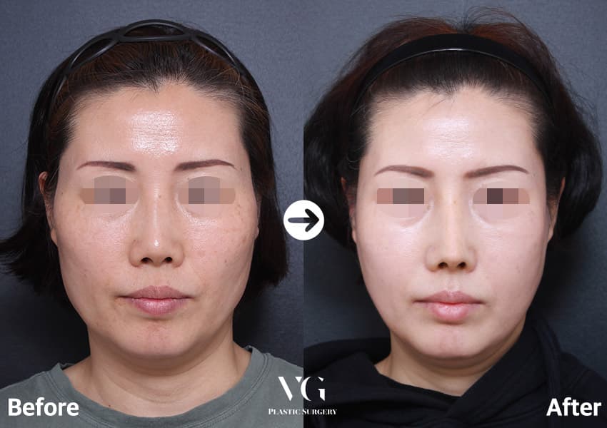 Cheekbone (Zygoma) Reduction + Square Jaw Reduction + Revision Rhinoplasty