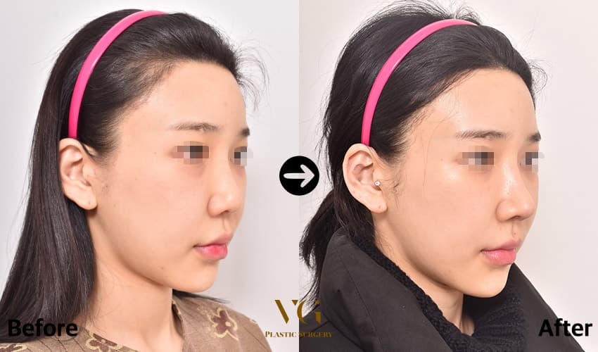 Revision Rhinoplasty + Donor Rib Cartilage