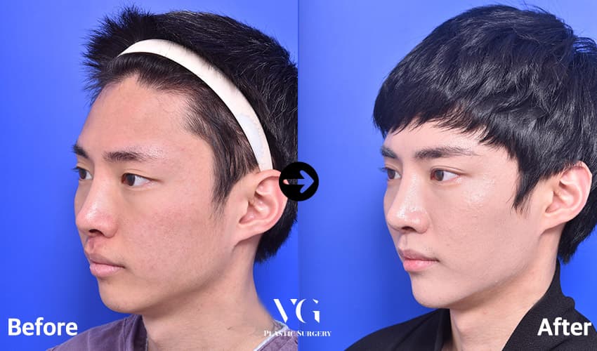 Revision Rhinoplasty + Deviated Nose Correction + Alar Base Reduction +1