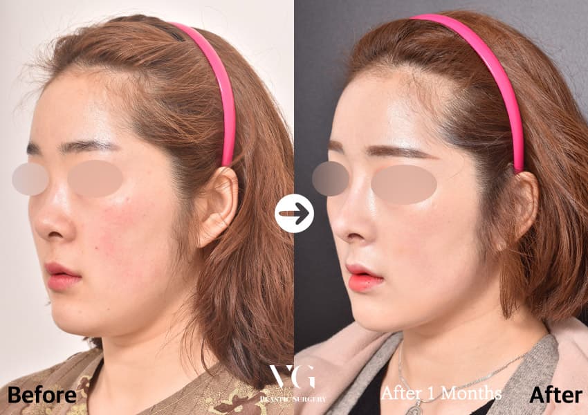 Rhinoplasty + Donor Rib Cartilage