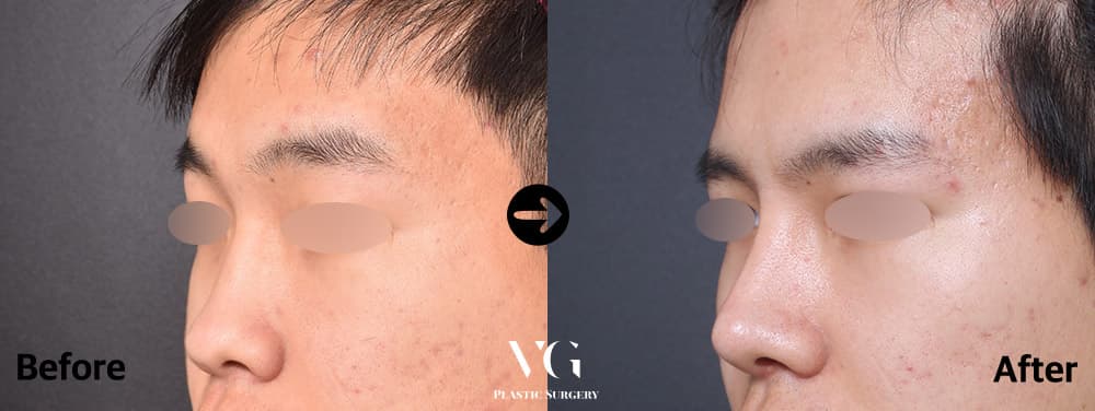 Male Rhinoplasty