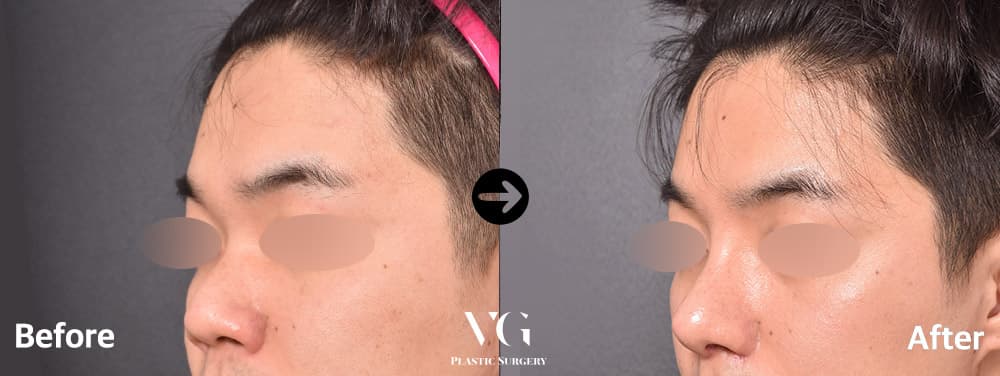 Male Rhinoplasty + Alar Base Reduction + Short Nose Correction +1