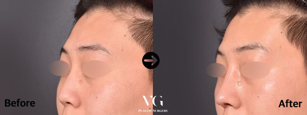Male Rhinoplasty + Autologous Rib Cartilage