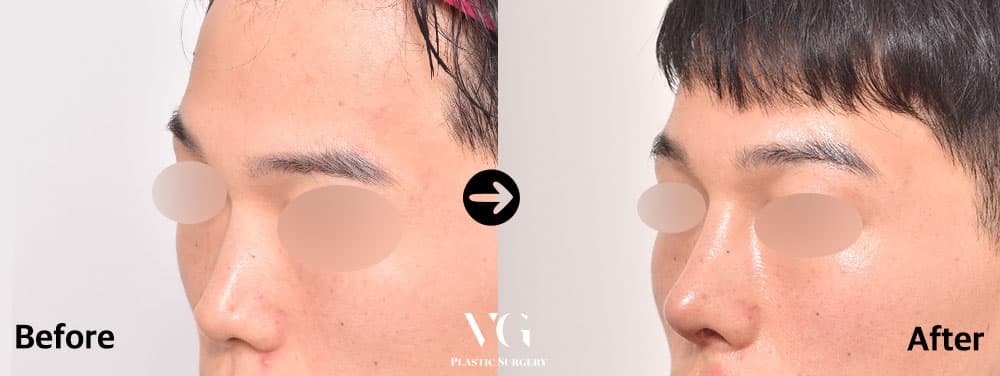 Revision Rhinoplasty + Autologous Rib Cartilage