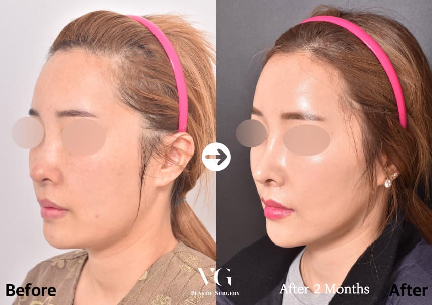 Rhinoplasty + Double-Chin Liposuction + Thread Lift