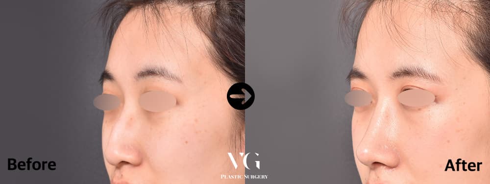 Rhinoplasty + Hump Reduction + Alar Base Reduction