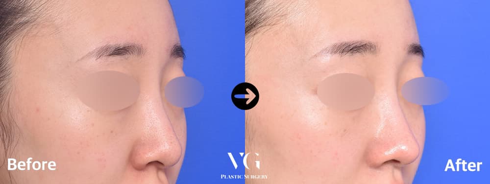 Tip Plasty + Alar Base Reduction