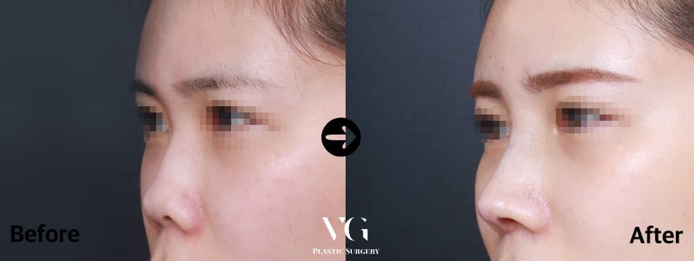 Rhinoplasty + Short Nose Correction + Autologous Rib Cartilage