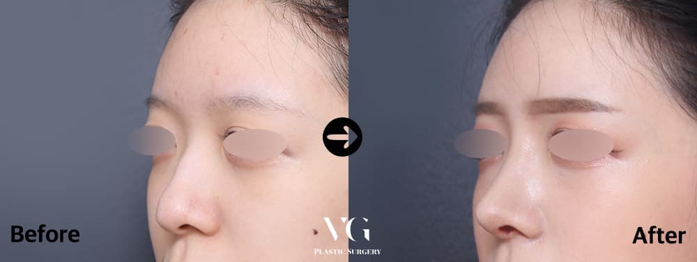 Rhinoplasty + Hump Reduction + Alar Base Reduction