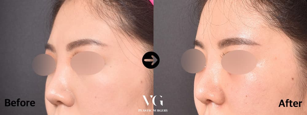 Revision Rhinoplasty + Donor Rib Cartilage