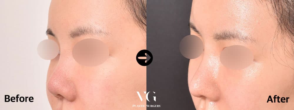 Revision Rhinoplasty + Autologous Rib Cartilage