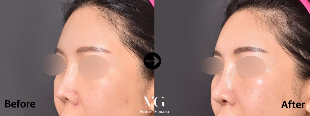 Revision Rhinoplasty + Donor Rib Cartilage