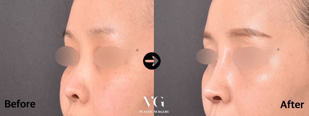 Revision Rhinoplasty + Autologous Rib Cartilage