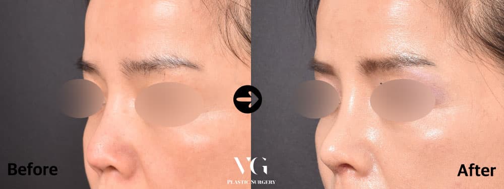 Revision Rhinoplasty + Donor Rib Cartilage