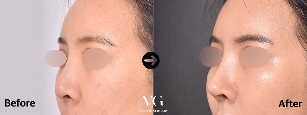Revision Rhinoplasty + Donor Rib Cartilage