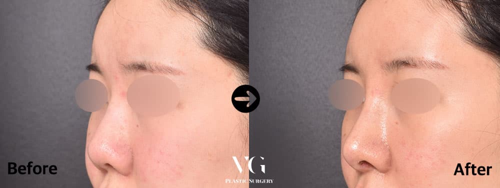 Revision Rhinoplasty + Autologous Rib Cartilage