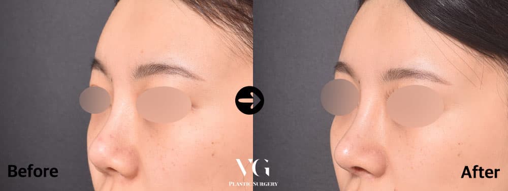 Revision Rhinoplasty + Donor Rib Cartilage