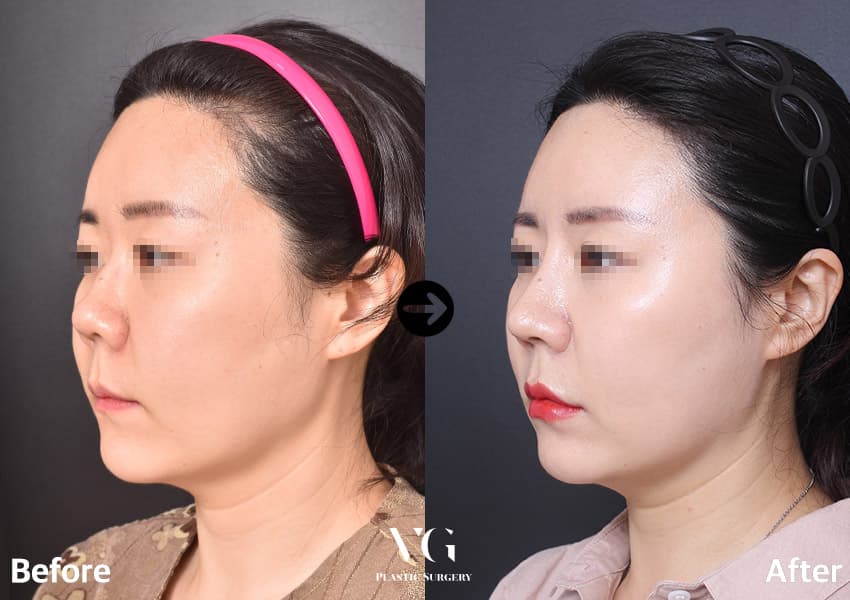 Rhinoplasty + Short Nose Correction + Hump Reduction