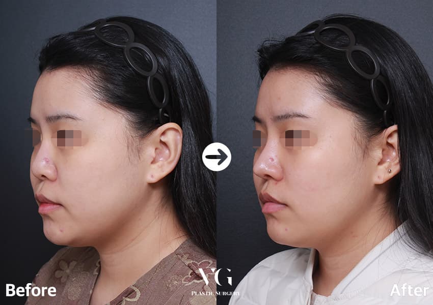 Revision Rhinoplasty + Autologous Rib Cartilage