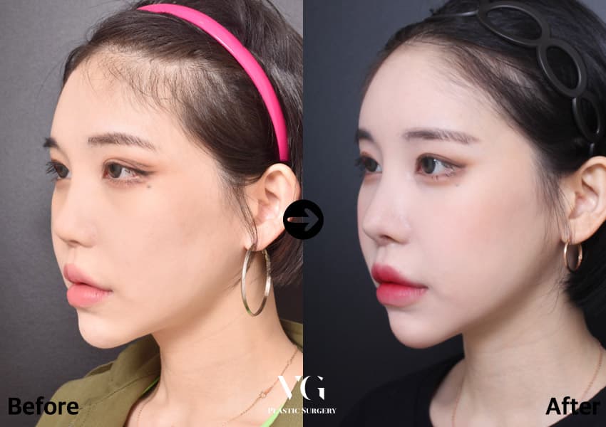 Revision Rhinoplasty + Donor Rib Cartilage
