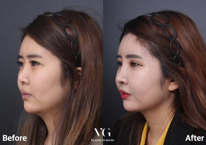 Revision Rhinoplasty + Autologous Rib Cartilage + Cheekbone (Zygoma) Reduction