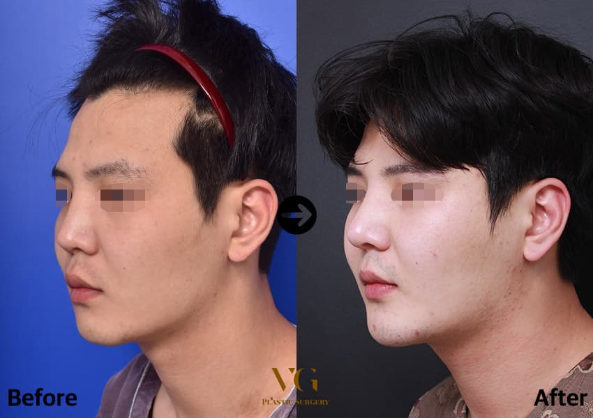 Rhinoplasty + Autologous Rib Cartilage + Cheekbone (Zygoma) Reduction