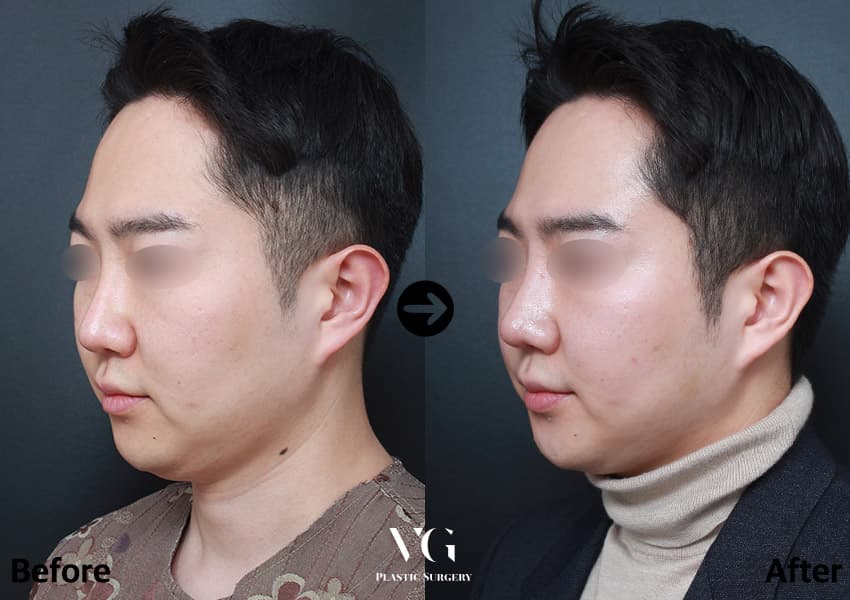 Rhinoplasty before and after — case 753