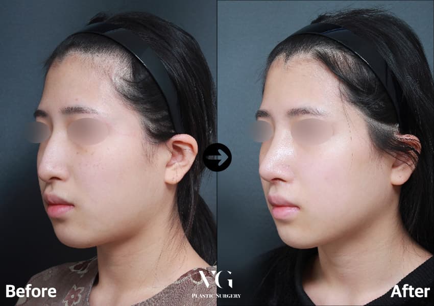 Tip Plasty + Hump Reduction