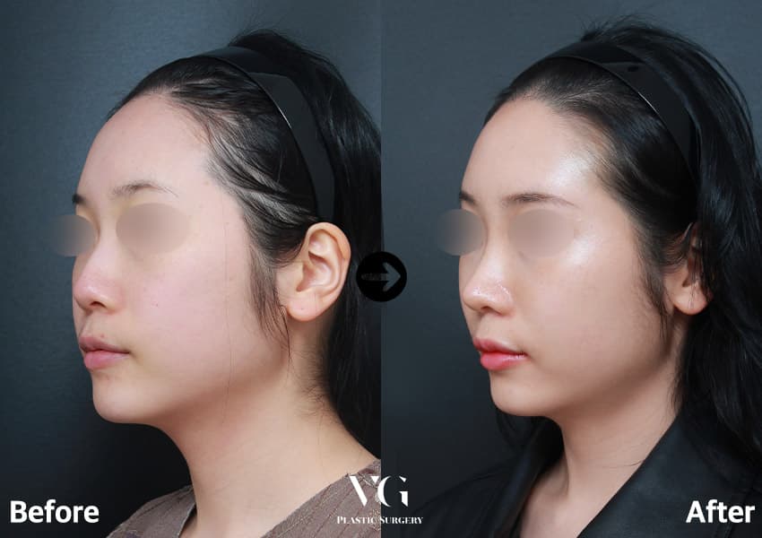 Tip Plasty + Alar Base Reduction + Bulbous Tip Correction